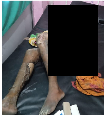 देवरले पेट्रोल छर्केर आगो लगाइदिएका भाउजुको उपचारका क्रममा मृत्यु, अढाई वर्षिया छोरी घाइते फरार देवरको खोजी कार्य जारि ः प्रहरी